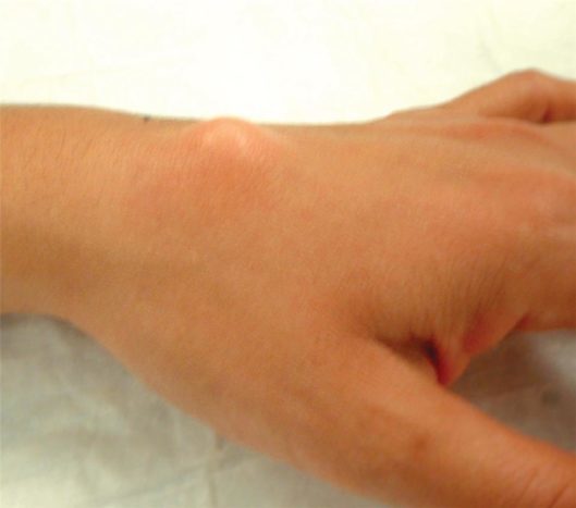 ऊपरी कलाई कलाई नाड़ीग्रन्थि पुटी (स्रोत: अमेरिकन सोसायटी फॉर सर्जरी ऑफ द हैंड)