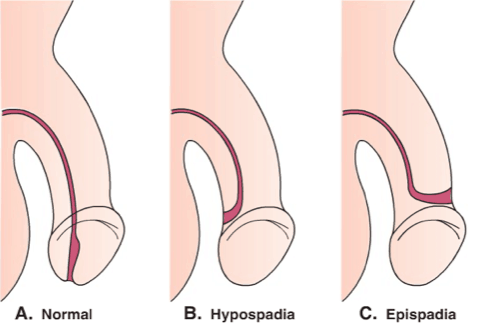 लिंग का छेद सामान्य नहीं है, हाइपोस्पेडिया के एपिसोड