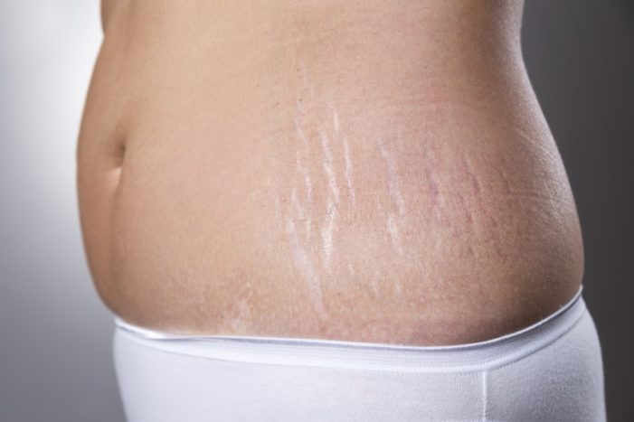 गर्भवती होने पर खिंचाव के निशान को रोकने के लिए टिप्स