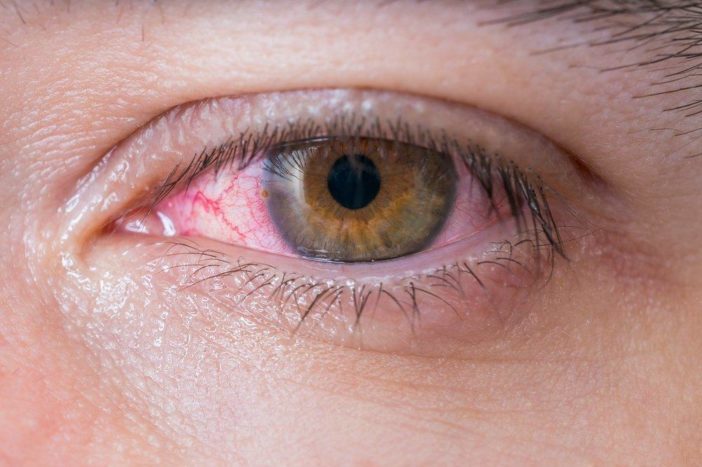 एलर्जी लाल आंख नेत्रश्लेष्मलाशोथ