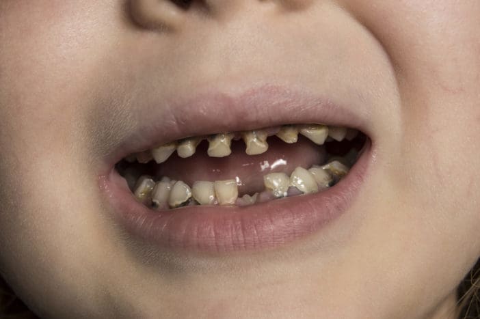 बच्चों के दांतों की सड़न के लिए बेबी बोतल के दांतों की सड़न