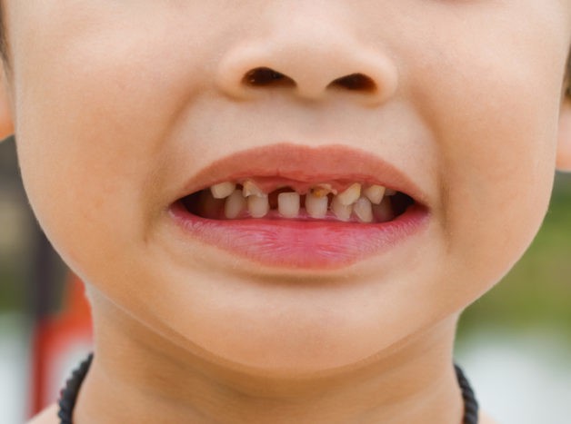 बच्चों के दांतों को नुकसान
